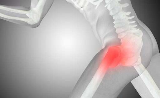 Ostéoarthrite articulaire de la hanche