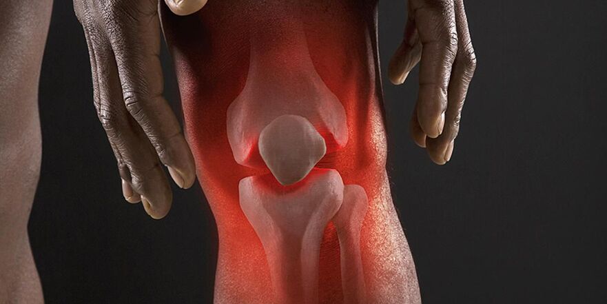 Une sensation de brûlure au niveau du genou est un symptôme de gonarthrose.